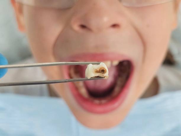 Best Chipped Tooth Repair Near Me  in Bountiful, UT
